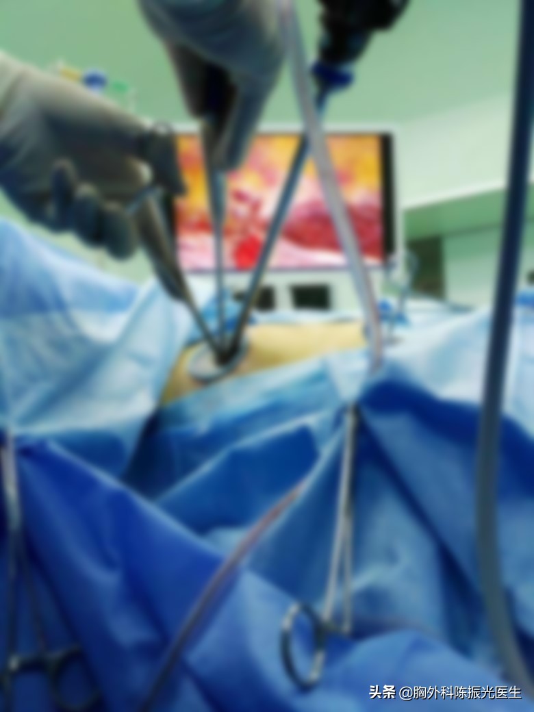 胸腔镜肺结节手术住院几天出院,肺结节微创胸腔镜手术要多长时间