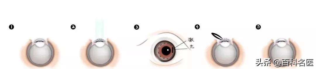 近视眼矫正的四种手术,近视眼如何通过手术矫正