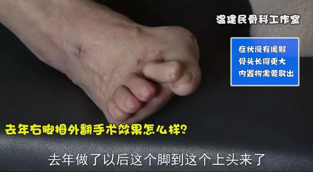 71岁患者为治拇外翻被切脚趾，畸形疼痛更严重！重修后终于不疼了