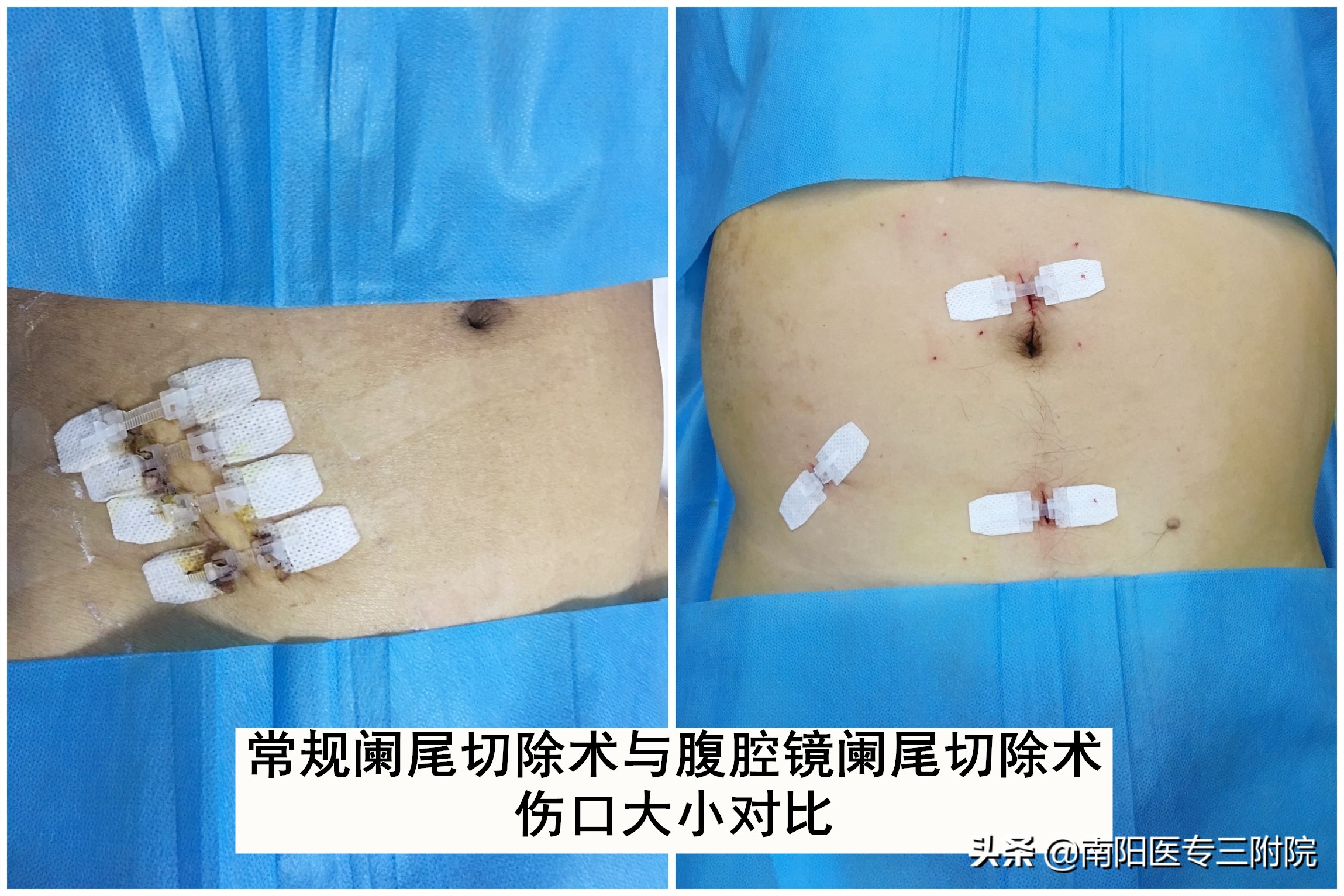 南阳医专第三附属医院手术费用,南阳市医院腹腔镜