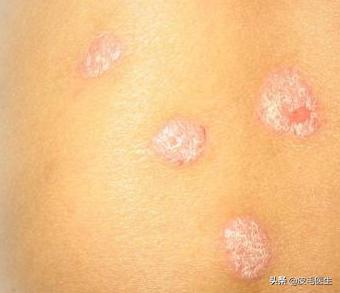 浑身瘙痒有很多皮屑,浑身瘙痒起鸡皮疙瘩怎么回事