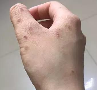 夏季湿疹高发期，如何用药是关键