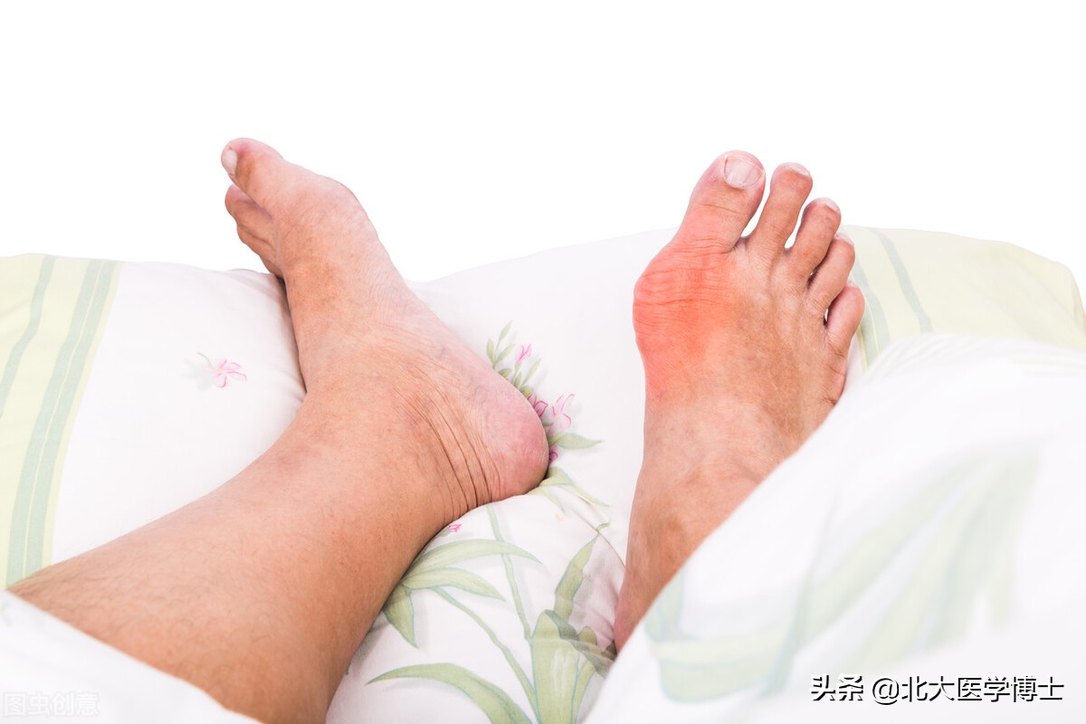 从妈妈身体遗传下来的乙肝,遗传性痛风是不是尿酸控制不住的