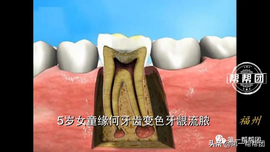 小孩牙齿烂掉牙龈有脓包,5岁女童牙龈反复化脓