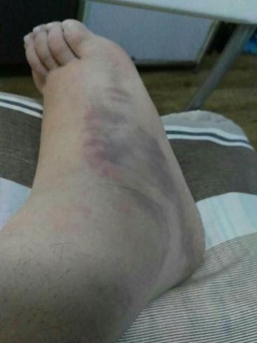 骨科医生告诉你崴脚了怎么办,急性脚扭伤正确的处理方法