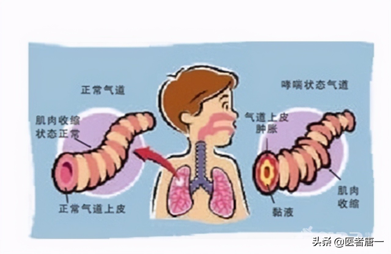 支气管哮喘规范治疗要多久出效果,支气管哮喘治疗分级