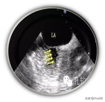 早产儿心脏卵圆孔未闭,卵圆孔未闭的原因