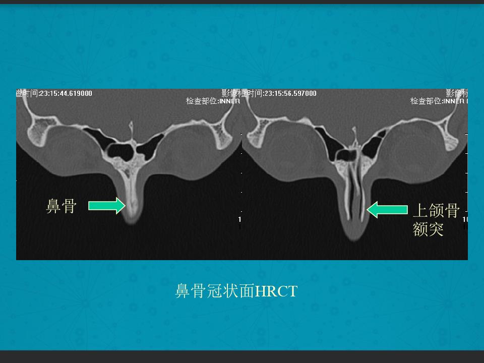 鼻骨骨折复位全过程,诊断证明鼻骨骨折问号是什么意思