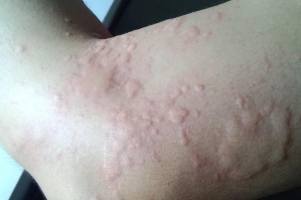 河边小黑蚊子咬人很痒,比芝麻还小的黑色蚊子怎么消灭