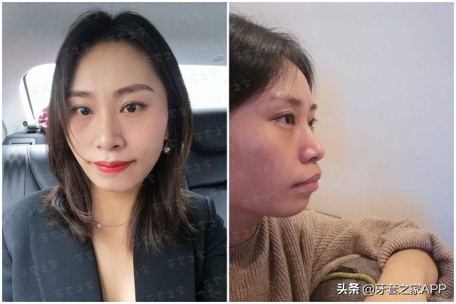 拔牙和打骨钉哪个更痛,矫正牙齿拔牙后一定要打骨钉吗