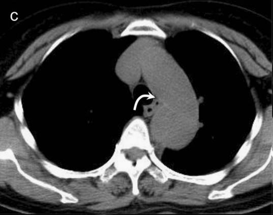 肠系膜上动脉夹层,心脏动脉夹层破裂