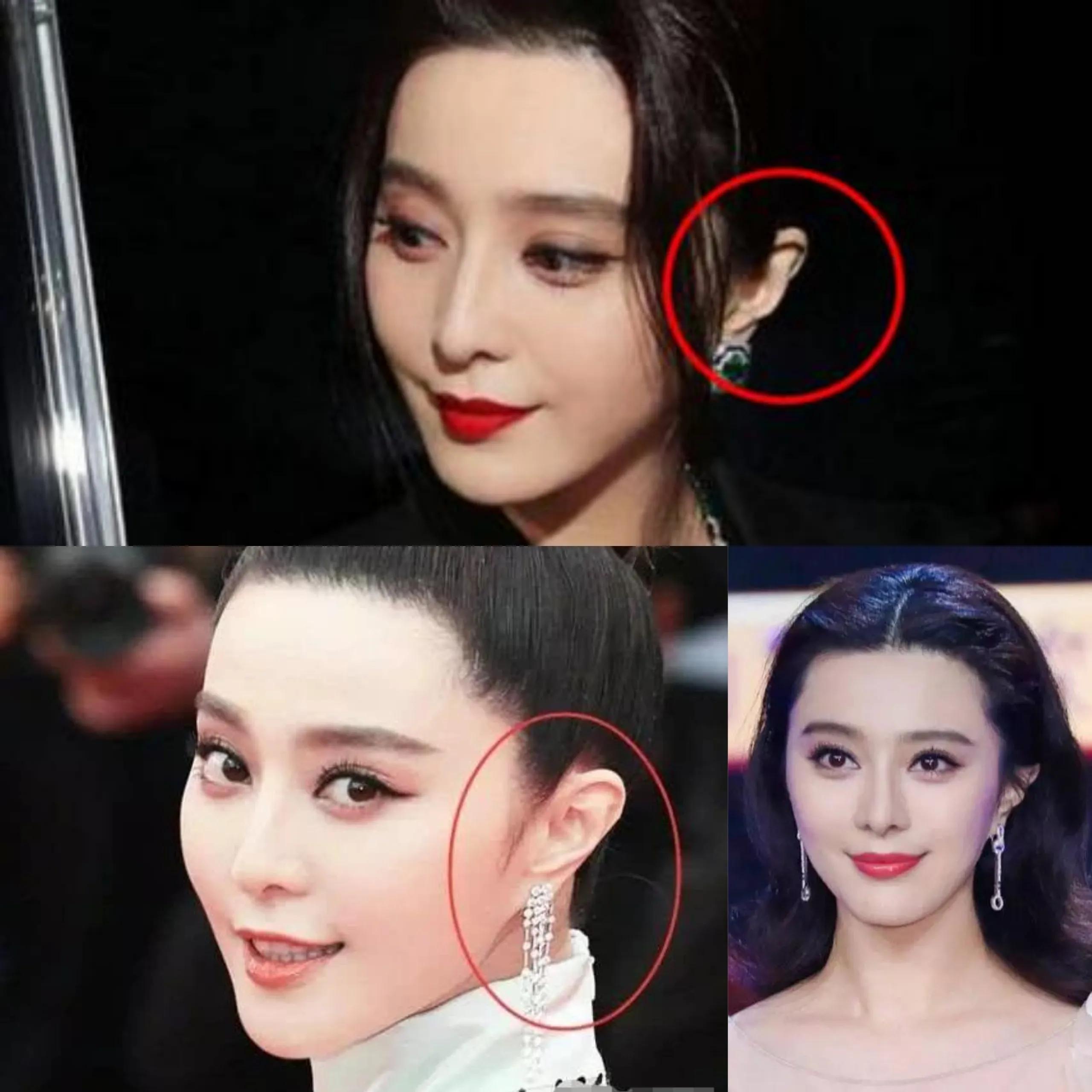 20万玻尿酸,一连打6支玻尿酸会怎么样