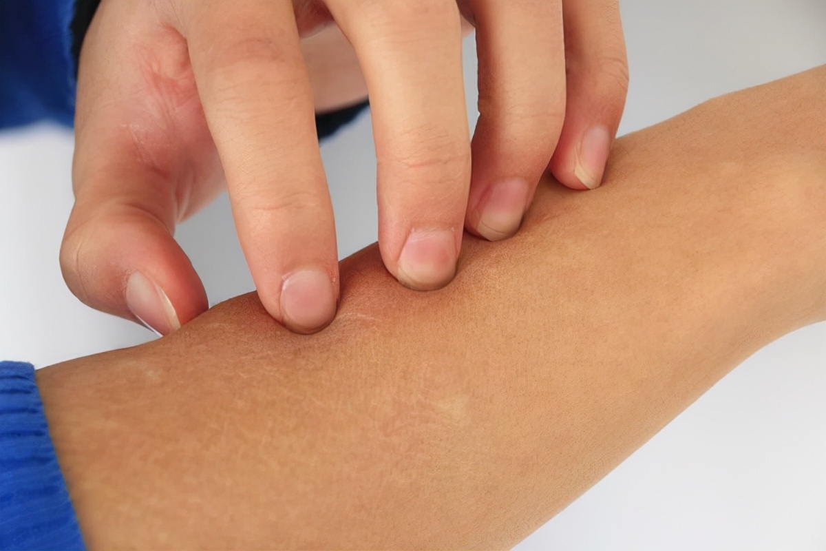 天气冷了为什么皮屑多了,天气干燥起癣的原因