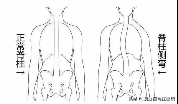 小孩走路弓腰驼背练什么锻炼气质,小孩子改善驼背和脖子前倾的运动