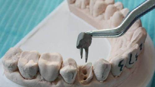 牙齿根管治疗不做牙套是什么样子,牙齿治疗中需要避开的误区