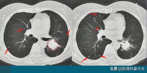 三种情况发现是肺癌晚期,晚期肺癌不咳嗽爱睡觉是怎么回事