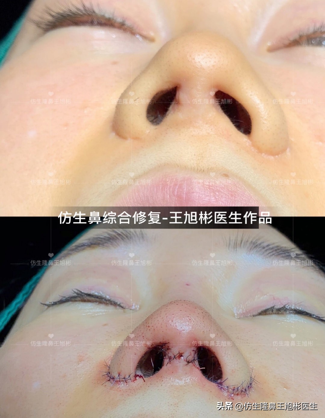 隆鼻的骨粉不取出有什么危害,骨粉隆鼻没有不适需要取出吗