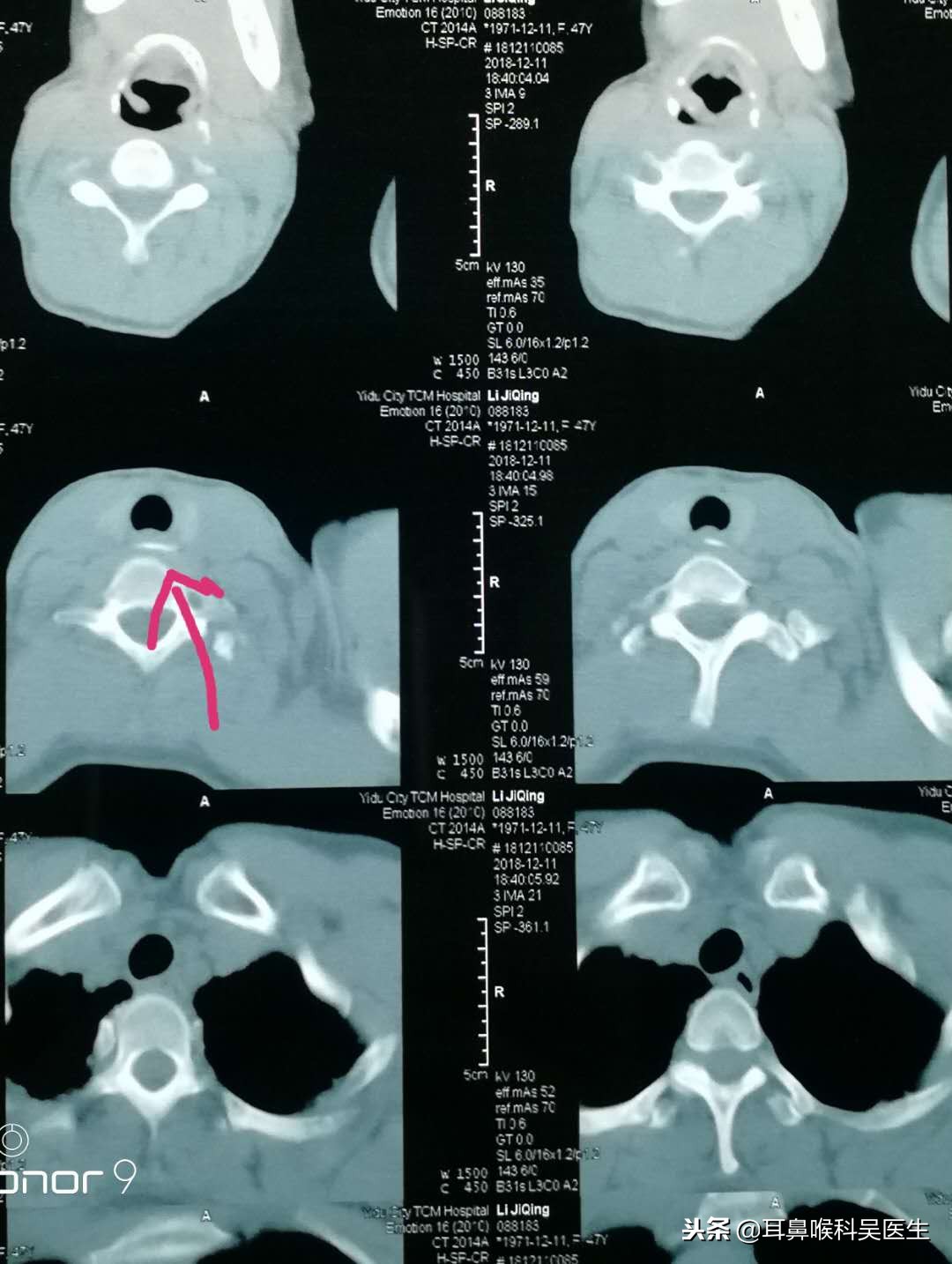 小孩吞异物卡住的症状,被异物卡住了该怎么办