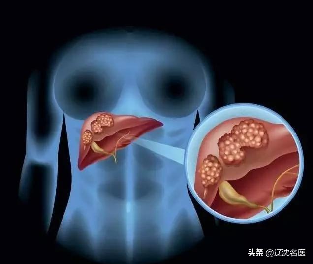 巨块肝癌最新治疗方法,肝癌介入治疗方法