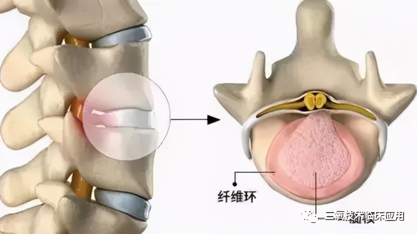 臭氧注射在椎间盘源性疼痛诊断和治疗中的研究