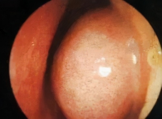 宝宝鼻塞流鼻涕不吃药怎么治,宝宝流鼻涕鼻塞不吃药怎么治疗