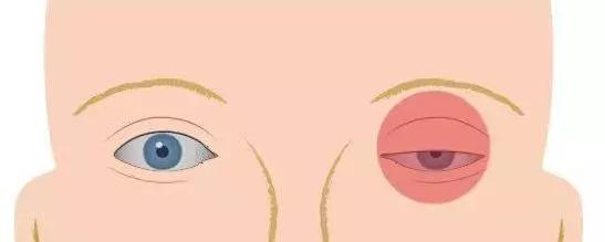 面肌痉挛右眼皮跳北京哪里治疗,眼皮一直抽搐跳动的原因面肌痉挛