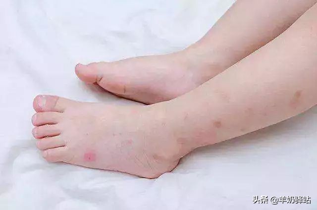 用什么方法防止虫叮咬最好,夏天蚊虫叮咬教你灭虫小姿势