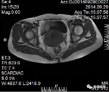 宫颈癌mri诊断,宫颈癌的mr扫描技术