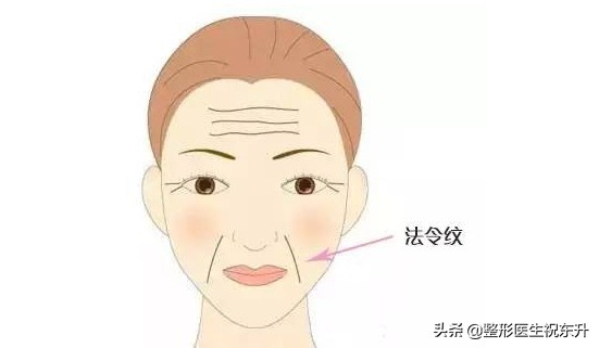 法令纹不做医美可以去除吗,祛除法令纹做什么手术效果好