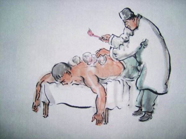 拔罐治疗疾病的方法,拔罐治疗病症及穴位