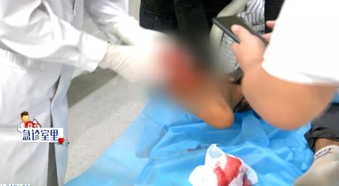 切割机切到手指要打破伤风吗,手指被切割机切断了还能接