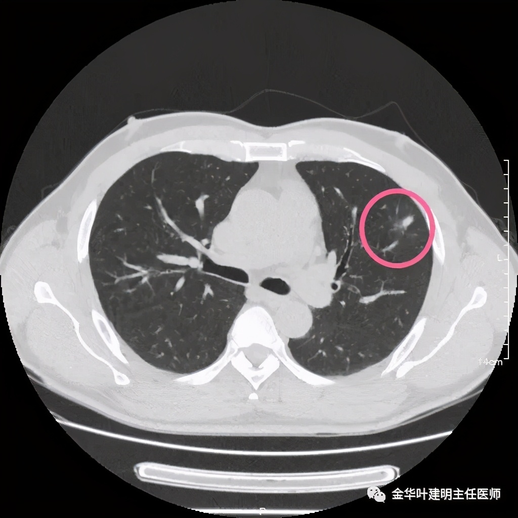 叶建明谈肺结节:一招分辨隐球菌性肉芽肿与肺癌