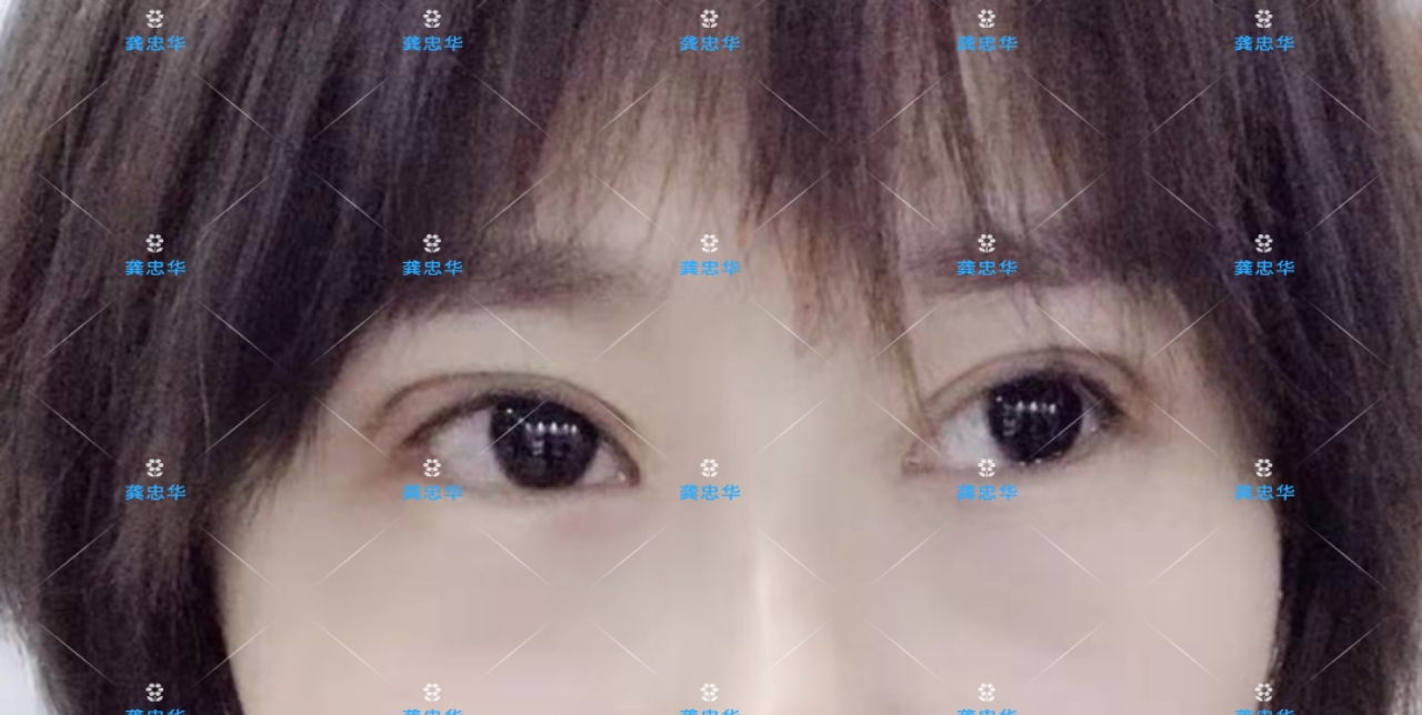 眼皮松弛可以做埋线双眼皮吗,埋线双眼皮眼皮松弛了该怎么办