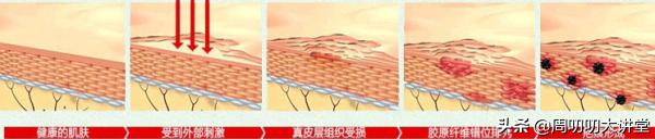 早期凹陷疤痕怎么修复,早期疤痕激光干预能改善多少