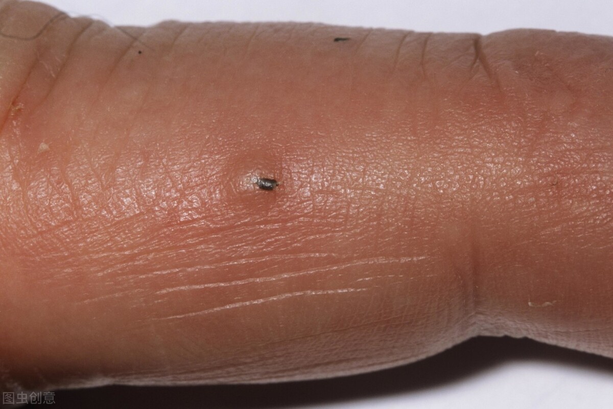 85岁老人胳膊上长小肉粒溃烂,老人手臂肉肿块贴啥药膏