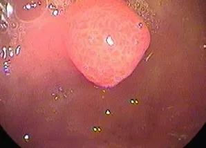 胃息肉一定能癌变吗,胃息肉会癌变吗