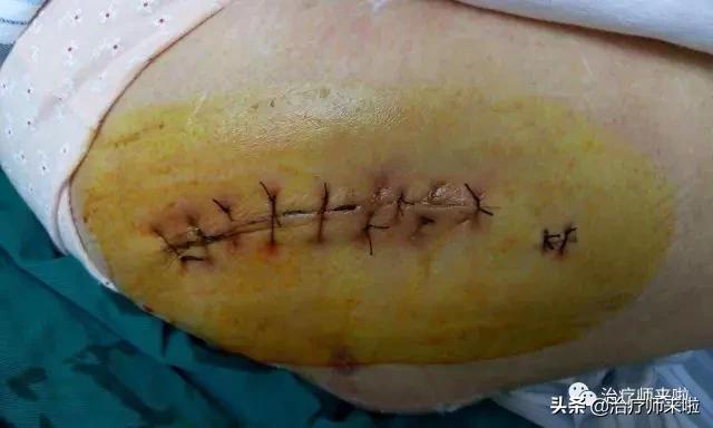 髋关节术后半年康复,髋关节术后早期康复