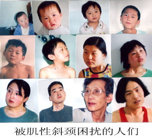 小孩脖子有点歪怎么矫正视频,孩子的脖子歪了怎么办