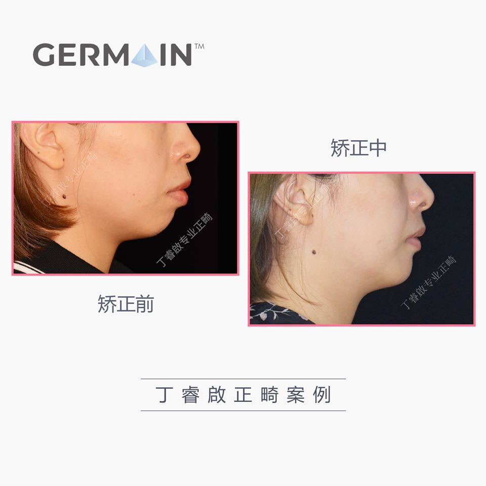 郑州牙齿矫正丁睿啟｜下巴后缩病例合集