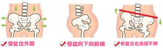 骨盆歪造成的脸歪能恢复吗,骨盆为什么会前倾最快纠正法