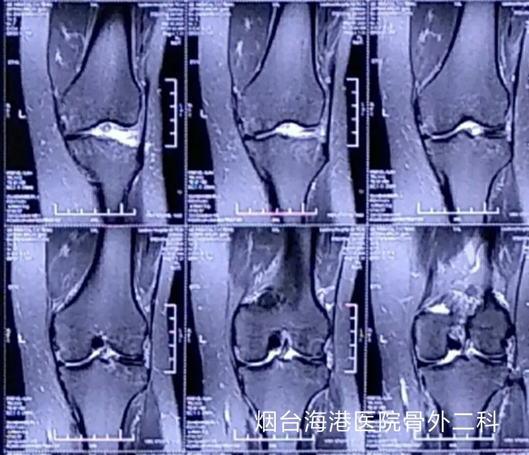 半月板手术导致骨性关节炎怎么办,关节镜治疗半月板损伤后遗症