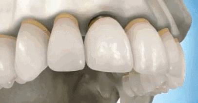 最先进的牙齿纠正,成年人不能忽略的22个牙齿问题