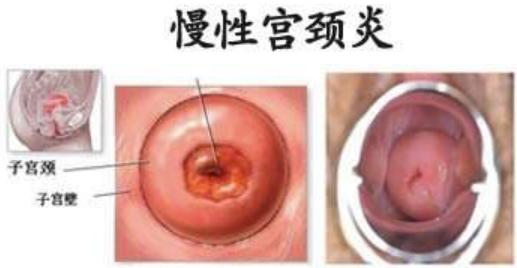 肚子不舒服,下腹坠胀,会不会是宫颈炎?
