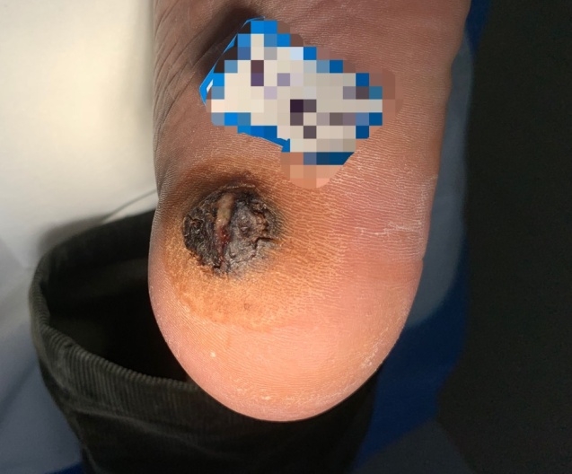 脚底长“痣”反复修，检查竟是黑色素瘤