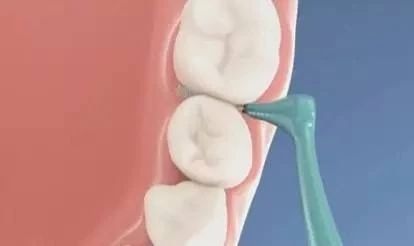 有严重牙周病能种牙么,得了牙周病还能刷牙吗