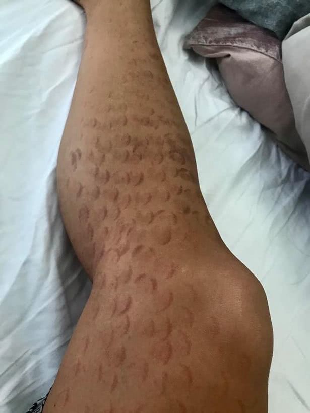 加拿大女子被烧伤,温哥华妹子花7000加币激光脱毛