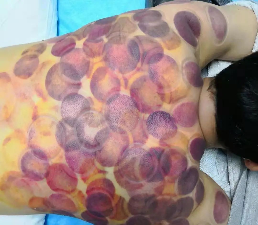 男人排湿气最快的方法拔罐祛湿气,拔罐拔哪几个穴位祛湿气效果最好