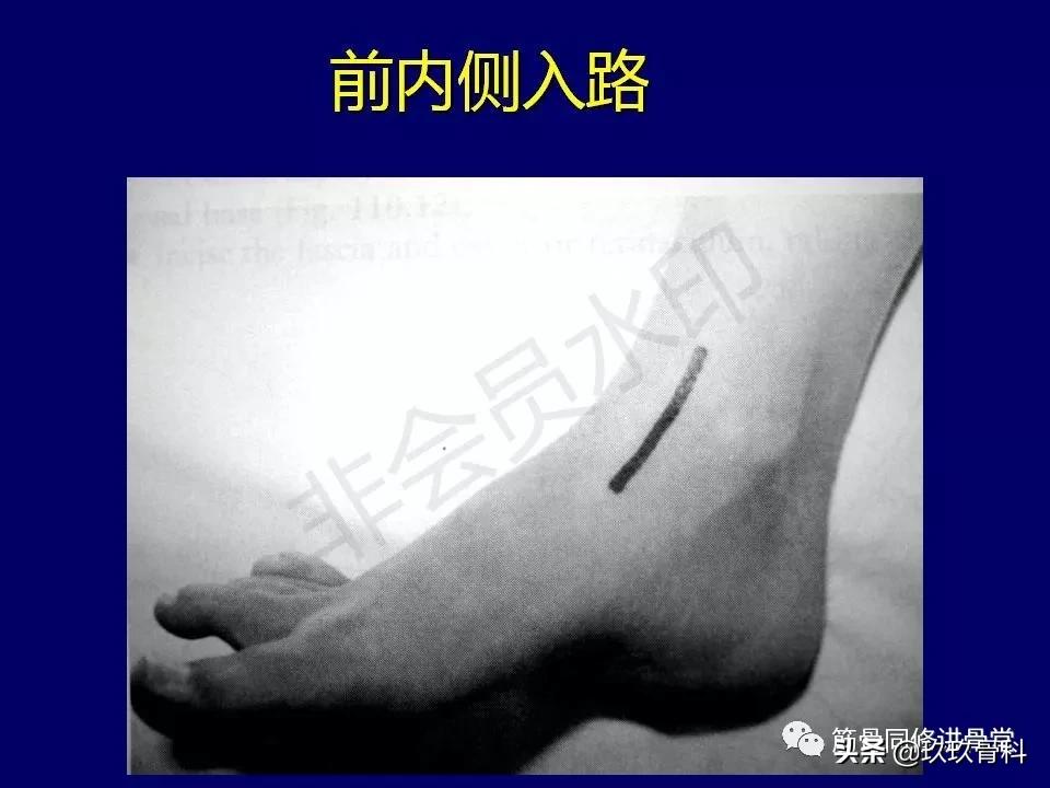 距骨骨折的治疗原则,距骨骨折如何调理