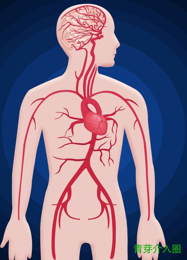 颅内动脉瘤介入栓塞支架全过程,颅内夹层动脉瘤介入演示