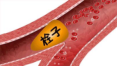 血栓辟谣,经常运动血栓